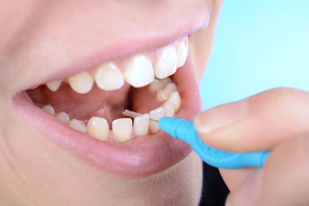 A visual guide to selecting the appropriate interdental toothbrush based on size, bristles, and design for effective oral hygiene and preventing dental issues.