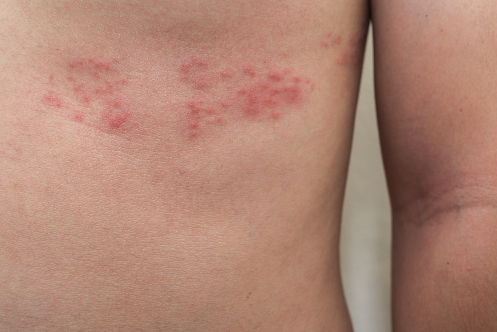 Shingles – symptoms and treatment