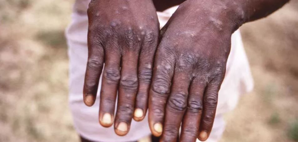 Skin after monkeypox